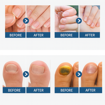 FungiCare Nail Repair Patches™